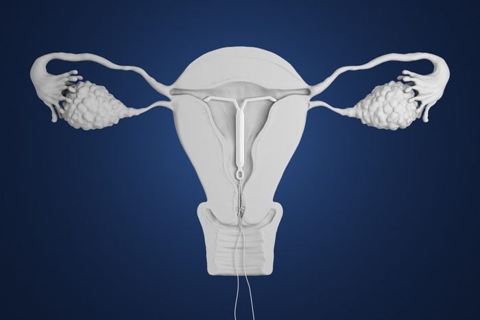 Hormonal vs Non-Hormonal IUD for Birth Control