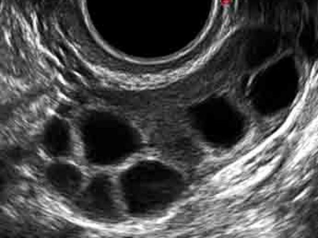 US of stimulated ovary (several follicles) - เชียงใหม่ ไอ.วี.เอฟ สหคลินิก 